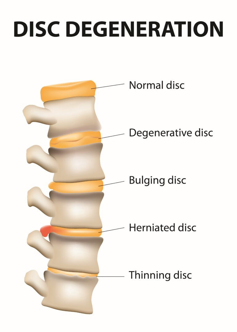 Understanding how disc degeneration can easily be seen by the decreased space between the vertebrae